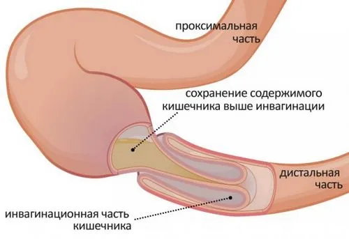 ніж лікувати дисбактеріоз кишечника у дітей