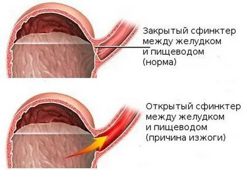 як лікувати печію у дітей