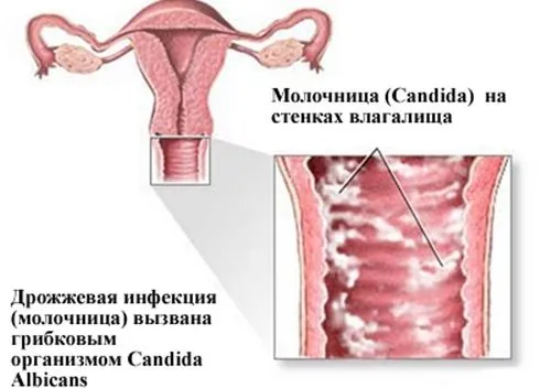 як лікувати грибковий кандидоз