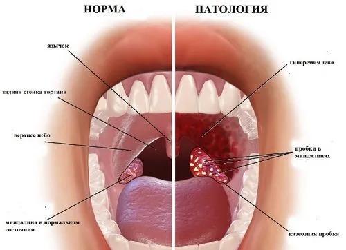 як лікувати мигдалини пробки