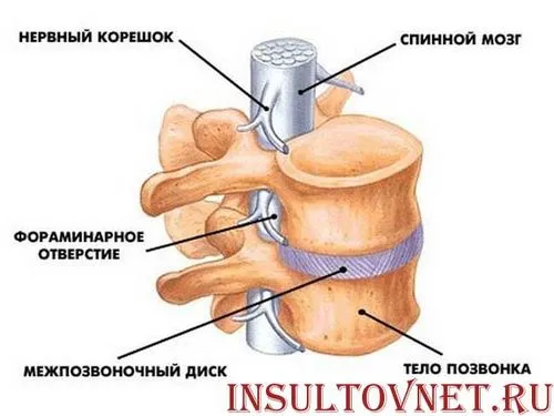 як лікувати спинальний інсульт