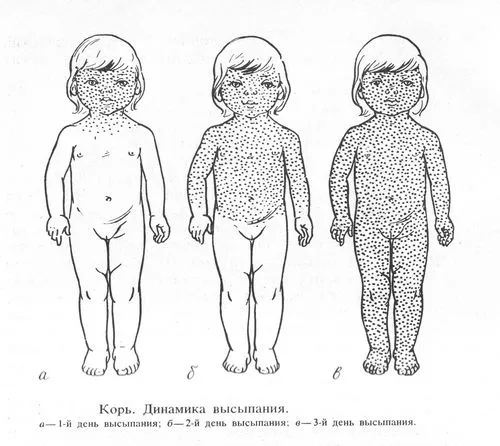 як лікувати інфекційний дерматит