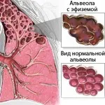 як лікувати емфізему легенів