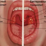 як лікувати фарингіт і ангіну