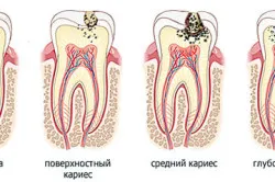 лікувати карієс на зубах