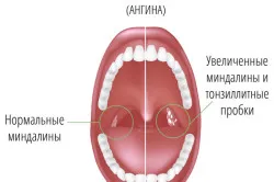 як лікувати вуха після ангіни