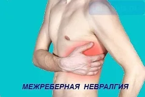 біль між ребер ознака поразки нерва