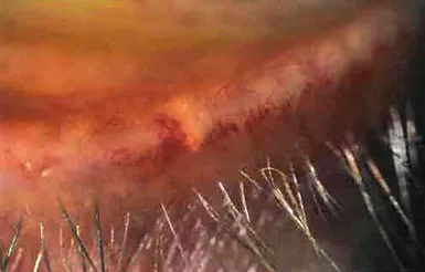 як лікувати мейбоміевий блефарит