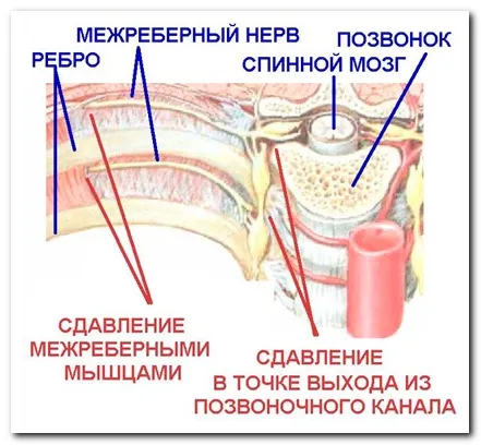 Як лікувати грудний радикуліт як лікувати грудний радикуліт