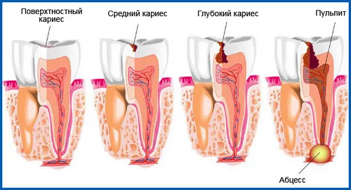 якщо не лікувати карієс що буде
