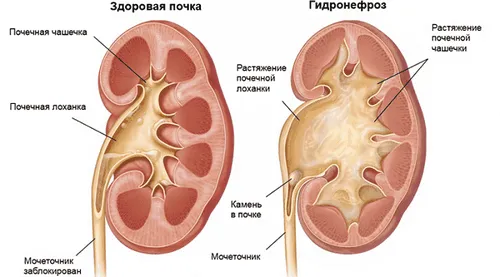 як лікувати нирки у жінок