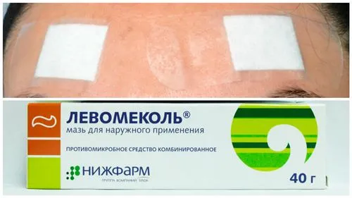 як лікувати фурункул в домашніх умовах