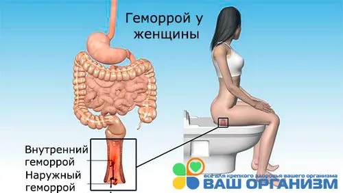 як лікувати геморой у жінок