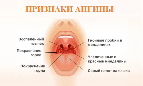 чи потрібно лікувати тонзиліт