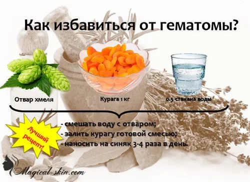 як лікувати величезний синяк