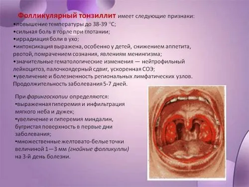 чи потрібно лікувати тонзиліт