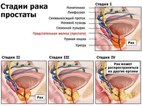 як вилікувати рак без операції