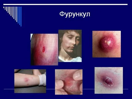як лікувати фурункул зсередини
