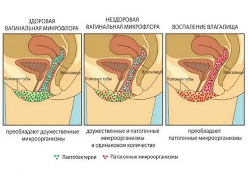Як лікувати кольпіт? як лікувати кольпіт будинку