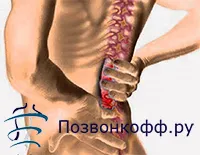 поперековий радикуліт лікування