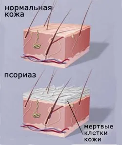 як ефективно лікувати псоріаз