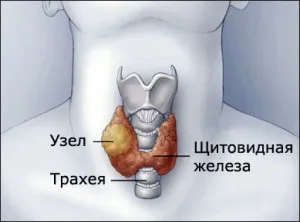 як лікувати паренхіматозний зоб