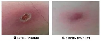вилікувати фурункул в домашніх умовах