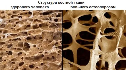 Який лікар лікує остеопороз лікар лікуючий остеопороз