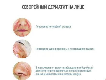 дерматит себорейний лікування на обличчі