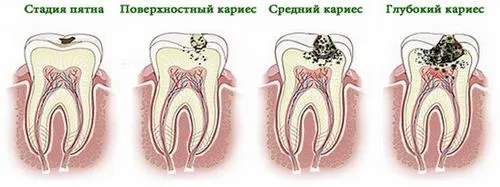 карієс зубів