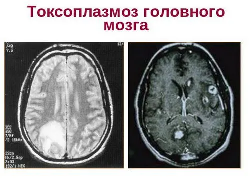 токсоплазмоз лікувати чи ні