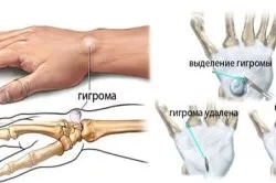 про кісту