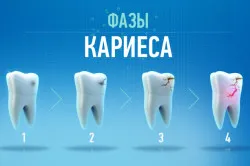 як вилікувати карієс на передніх зубах