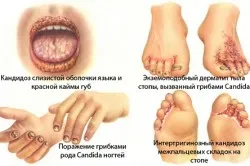 як лікувати кандидоз у роті