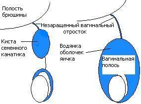 фуникулоцеле