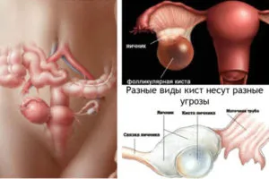 як вилікувати кісту правого яєчника
