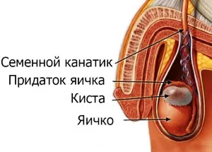 кіста придатка правого яєчка