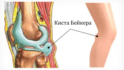 як лікувати кісту в коліні