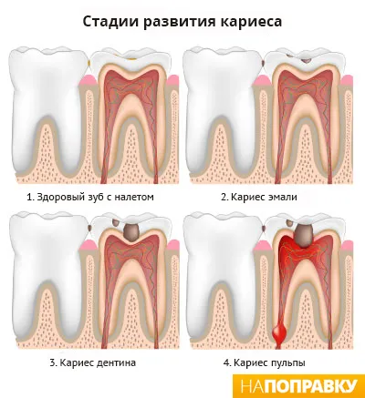 карієс