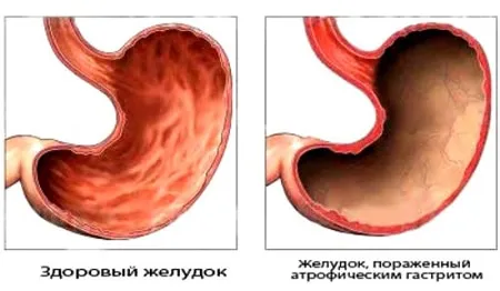 як вилікувати шлунок гастрит