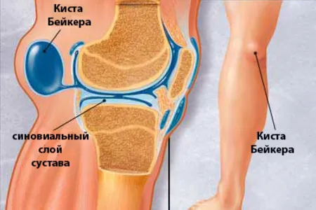 як лікувати кісту в коліні