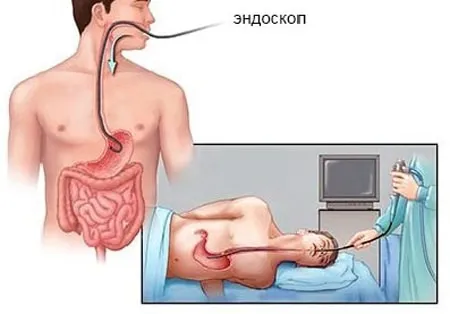 як вилікувати шлунок гастрит