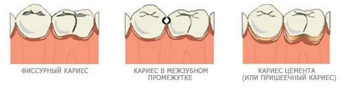 карієс у ясна