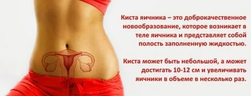 як лікувати кісту без операції