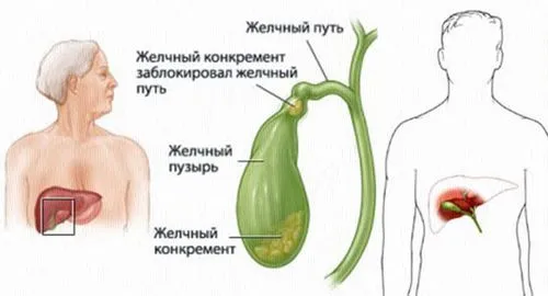 як лікувати холецистит травами
