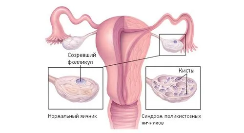 Кіста яєчника: лікування антибіотиками як вилікувати кісту лівого яєчника