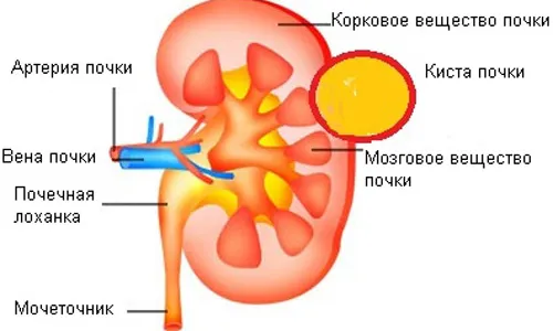 кіста нирки лікування народними засобами лопух