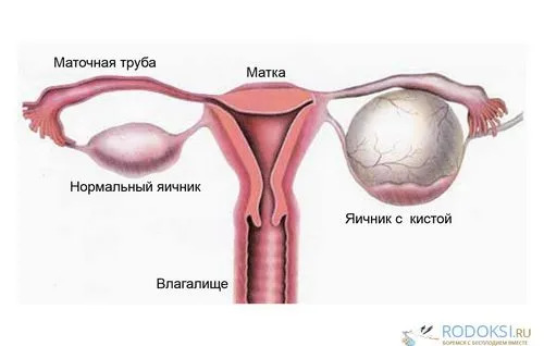 Кіста яєчника: причини, симптоми і методи лікування кіста яєчника причини симптоми метод лікування