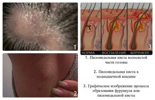 куприкова кіста