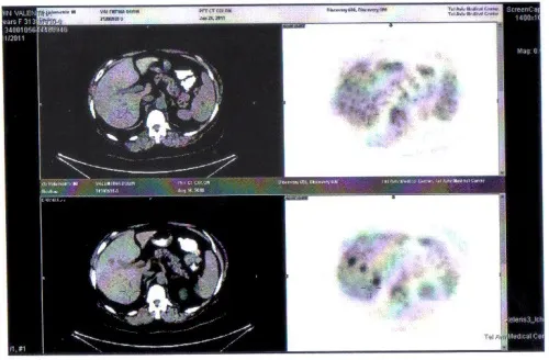Як вилікувати рак без хімії променева терапія